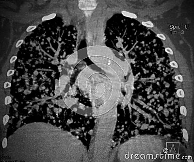 Cancer, lungs metastases. CT scan reconstruction. Stock Photo