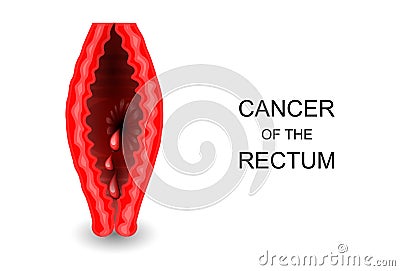 Cancer of the rectum Vector Illustration