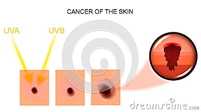 Cancer of the skin. Oncology Vector Illustration