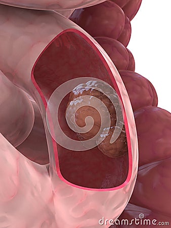 Cancer in small intestine Cartoon Illustration