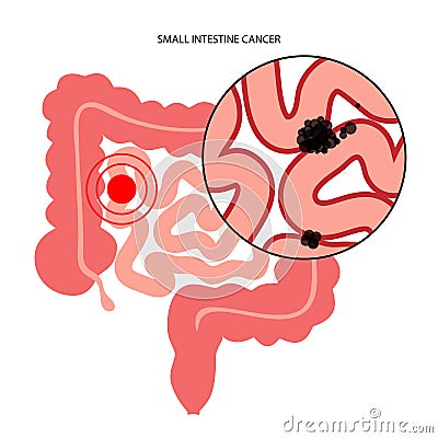 Small intestine cancer Vector Illustration