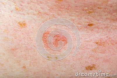 Candida infection on human skin Stock Photo