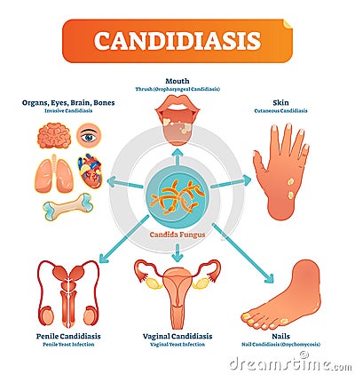 Candidiasis medical vector illustration diagram poster with all types of candida fungus on various human body parts and organs. Vector Illustration