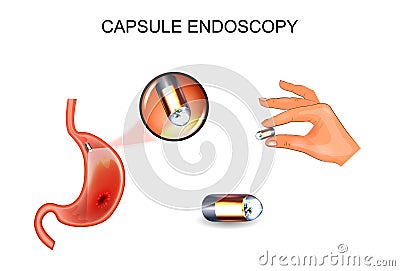 Capsule endoscopy. EGD, gastroenterology. Vector Illustration