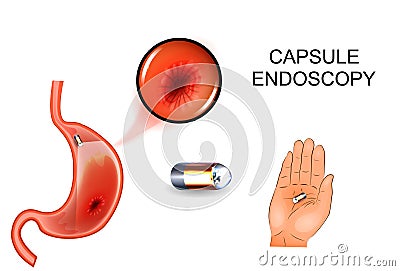 Capsule endoscopy, EGD, gastroenterology. Vector Illustration