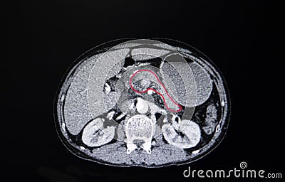 carcinoma of the head of pancreas Stock Photo