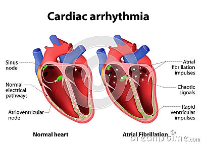 Cardiac arrhythmia Vector Illustration