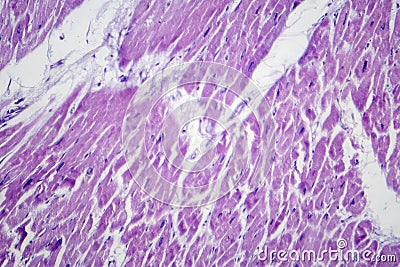 Cardiac hypertrophy, light micrograph Stock Photo