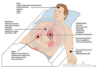 Cardiogenic shock Vector Illustration