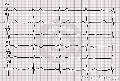 Cardiogram. Heartbeat. The graph on graph paper. Vector Illustration