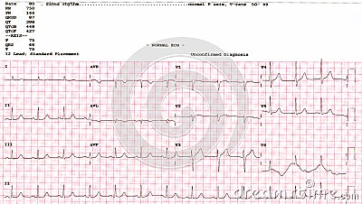 Cardiogram. waveform from an EKG showing normal EKG test. Stock Photo