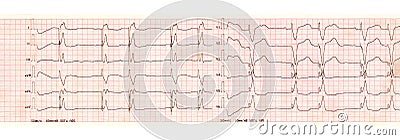 ECG with pacemaker arrhythmia ventricular stimulation Stock Photo