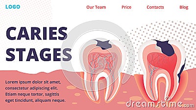 Caries Different Stages Treatment Vector Website Vector Illustration