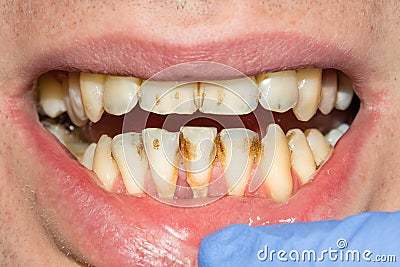 Caries spoiled tooth closeup photographed Stock Photo