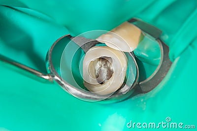 Caries spoiled tooth closeup photographed Stock Photo