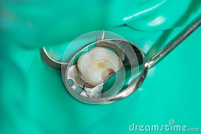 Caries spoiled tooth closeup photographed Stock Photo