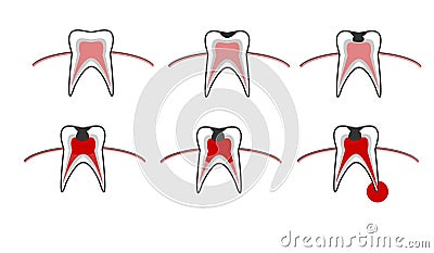 Caries stage, tooth decay scheme with caries, stomatological illustration with dental diseases, point by point schematic Vector Illustration