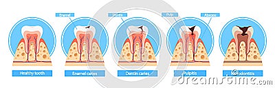 Caries Stages Infographics. Healthy Tooth, Enamel Caries, Dentin Caries, Pulpitis And Periodontitis Cross Section View Vector Illustration