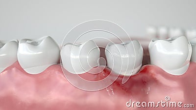 Caries in three stages - Stage 1 Gingivitis - 3D Rendering Stock Photo