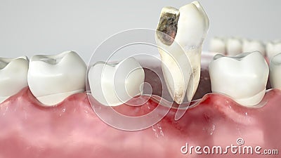 Caries in three stages - Stage 3 tooth extraction - 3D Rendering Stock Photo