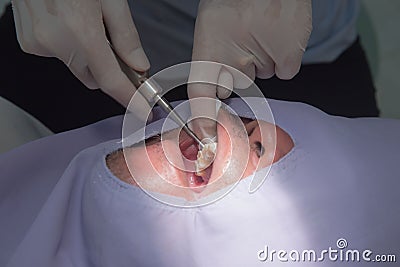 Caries tooth extraction by the dentist. Dentistry in hospital Stock Photo