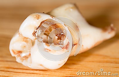 Caries in the tooth. macro Stock Photo