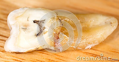 Caries in the tooth. macro Stock Photo