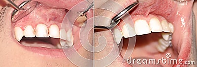 Caries before and after treatment Stock Photo