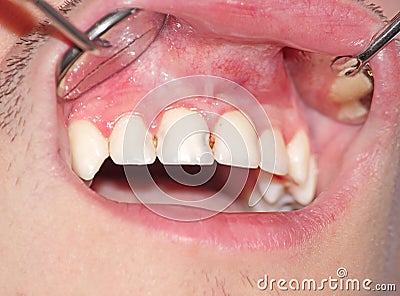 Caries of the upper incisors Stock Photo