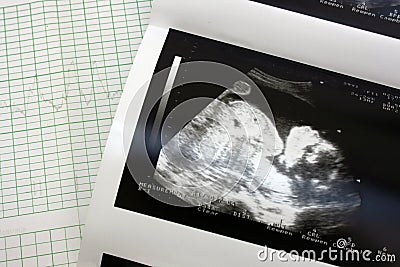 Cariograph and sonogram Stock Photo