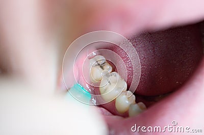 Carious lesions on chewing teeth, dental caries, aesthetic defect Stock Photo