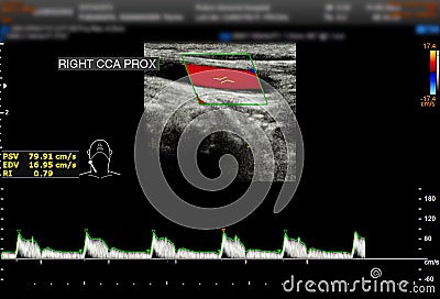 A carotid artery Doppler ultrasound is a diagnostic test used to check the arteries in the neck for diagnosis any blockage in the Stock Photo