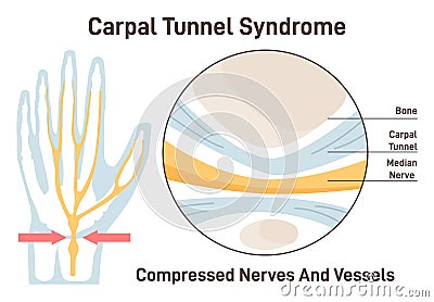 Carpal tunnel syndrome. Compressed median nerve. Carpal tunnel anatomy Vector Illustration