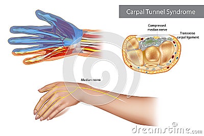 Carpal tunnel syndrome. Compressed median nerve. Anatomy of the carpal tunnel, showing the median nerve. Vector Illustration