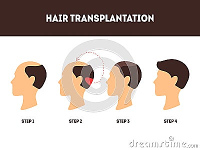 Cartoon Hair Transplant Surgery Card Poster. Vector Vector Illustration