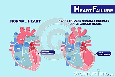 Heart failure concept Vector Illustration