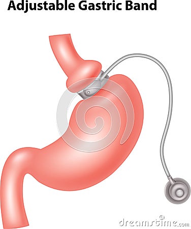 Cartoon illustration of Adjustable Gastric Band Vector Illustration