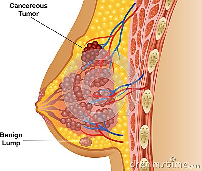 Cartoon illustration of cancerous breast tumor Vector Illustration