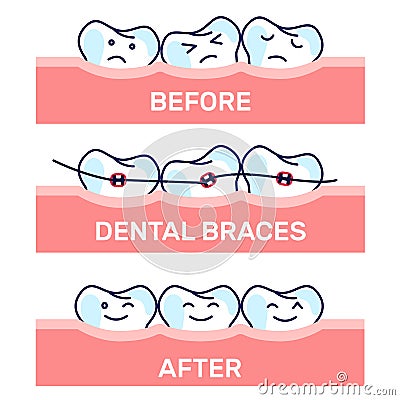 Cartoon kawaii funny teeth vector illustration, before and after brace correction. Concept of ortodontic treatment Vector Illustration