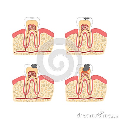 Cartoon Tooth with Stages of Dental Caries Formation Set. Vector Vector Illustration