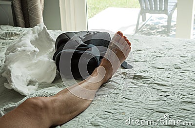 Cast removed from a foot after bunion surgery Stock Photo