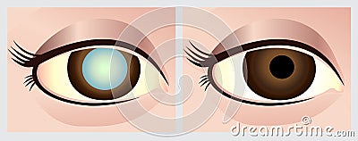 Cataract eye Stock Photo