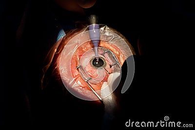 Cataract ophthalmologic surgery Stock Photo