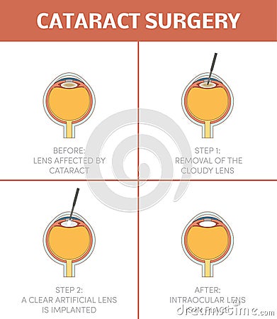 Cataract surgery, Stock Photo