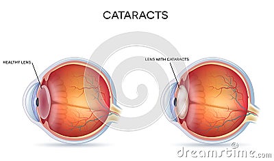 Cataracts Vector Illustration