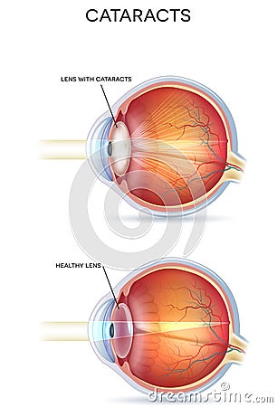 Cataracts Vector Illustration