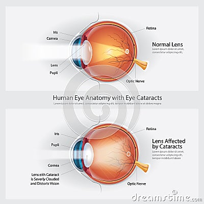 Cataracts Vision Disorder and Normal Eye Vision Anatomy Vector Illustration