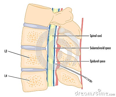 Catheter in epidural space Vector Illustration