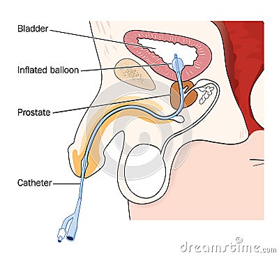 Catheter placed in male bladder Vector Illustration