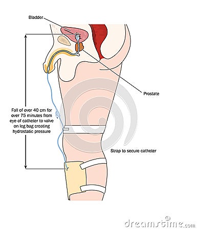 Catheter and urine bag Vector Illustration